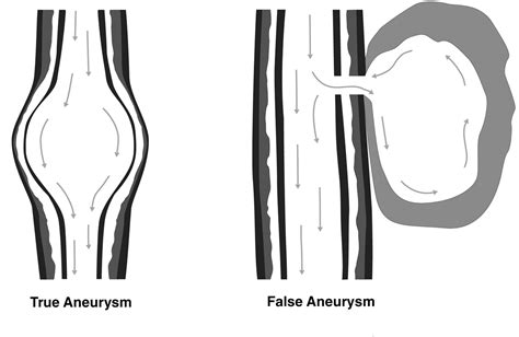 false aneurysm vs dissection.